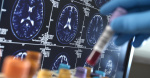 Familys genes offer new clue to delaying onset of Alzheimers disease  CBS News