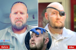 Worlds first wholeeye and partial face transplant patient reflects 1 year after surgery  New York Post Worlds first wholeeye and partial face transplant patient reflects 1 year after surgery  New York Post