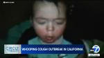 What are symptoms of whooping cough Outbreak hits California amid nationwide surge in pertussis  ABC7 Los Angeles