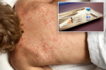 Texas measles cases swell to 48 marking states worst outbreak in three decades  New York Post Texas measles cases swell to 48 marking states worst outbreak in three decades  New York Post