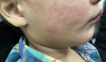 Texas measles outbreak grows Michigan Pennsylvania report new outbreaks  CIDRAP