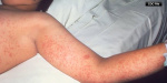 Potential measles exposure at Eisenhower Airport Hutchinson Library and auto shop in SW Kansas  KWCH