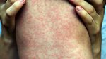 2 more Utahns diagnosed with measles bringing state total to 5  KSL News