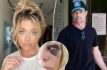 Aaron Phypers pal claims Denise Richards black eye was result of a drunken fall not abuse  Page Six Aaron Phypers pal claims Denise Richards black eye was result of a drunken fall not abuse  Page Six