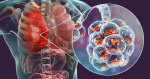 Legionnaires disease cluster in New York City causes 3 deaths sickens over 60 people What is it and how do you get it yahoocom Legionnaires disease cluster in New York City causes 3 deaths sickens over 60 people What is it and how do you get it yahoocom