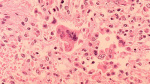 Los Angeles County child dies of rare measles complication years after infection  CNN