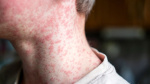 More than 2000 measles cases reported in the US this year as ongoing outbreaks threaten elimination status  CNN
