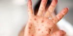 Adult with measles visited high school in Clark County while contagious officials say  kptvcom