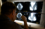 Opinion  We may be doing breast cancer screening all wrong  The Washington Post