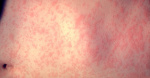 Measles case reported in Georgia  WSBTV