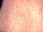 Measles could explode in Oregon in undervaccinated areas health officials warn  OregonLivecom