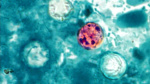 Cyclosporiasis outbreak CDC tracking cases in 31 states including Nebraska and Iowa  KETV