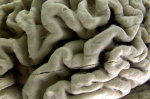 Study shows a blood test can help identify healthy people at high risk for Alzheimers disease  AP News