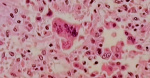 Delawares 4 new cases of measles meet criteria of outbreak  WDEL