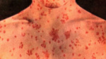 Measles outbreak in southern Iowa expands to 17 cases new potential exposure location added  KCCI