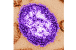 Pennsylvania reports first 2 measles deaths in the US this year both people unvaccinated  AP News