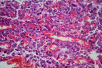 The screenings and other habits doctors recommend as earlyonset cancers rise  The Washington Post