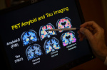Want to lower your risk of dementia It doesnt involve a blood test  AP News