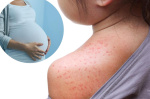Were literally seeing new forms of measles Infectious disease doc warns about scary Pennsylvania development  New York Post