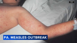 Health officials report 43 new measles cases in Pennsylvania since Monday state total now topping 800  6abc Philadelphia
