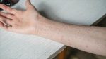 Oxford Area High School closed Friday after confirmed case of measles  6abc Philadelphia