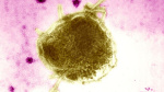 West Texas measles outbreak doubles to 48 cases  CNN West Texas measles outbreak doubles to 48 cases  CNN