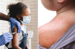 Measles outbreak surges 360 with 483 cases in 21 states  most coming from Texas  New York Post Measles outbreak surges 360 with 483 cases in 21 states  most coming from Texas  New York Post
