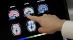 Shingles is awful but heres another reason to get vaccinated It may fight dementia AP News Shingles is awful but heres another reason to get vaccinated It may fight dementia AP News
