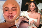 Chrissy Teigen gets hairline lowered in shocking plastic surgery procedure  Page Six