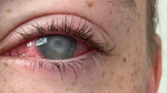 A blinding parasitic eye disease affects mostly contact lens wearers Heres how to avoid it  CNN