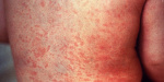 Maricopa County confirms sixth measles case possible Mesa and Queen Creek exposure sites  AZ Family