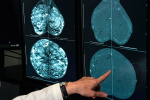 Cancer cases worldwide are expected to soar in the coming decades a report finds Heres why  The Washington Post