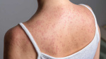 Iowa confirms its first measles case of 2026  KCCI