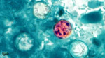 What we know about past outbreaks linked to cyclospora the parasite that can lead to explosive diarrhea  WCVB