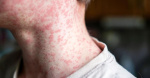 Measles outbreak in southwestern Wisconsin grows 2 cases confirmed in Grant County  Channel 3000