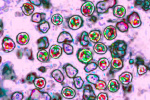 Infant died of measles in Pennsylvania coroner confirms  The Washington Post