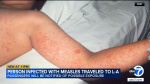 LA Union Station travelers may have been exposed to measles by infected passenger health officials warned  ABC7 Los Angeles